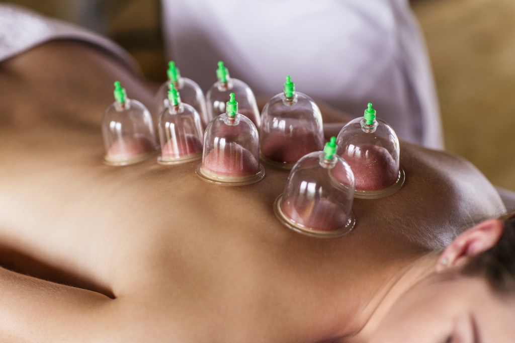 Woman laying on chest with cupping treatment on back